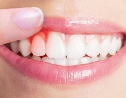 ĐIỀU TRỊ NHA CHU LÀ GÌ